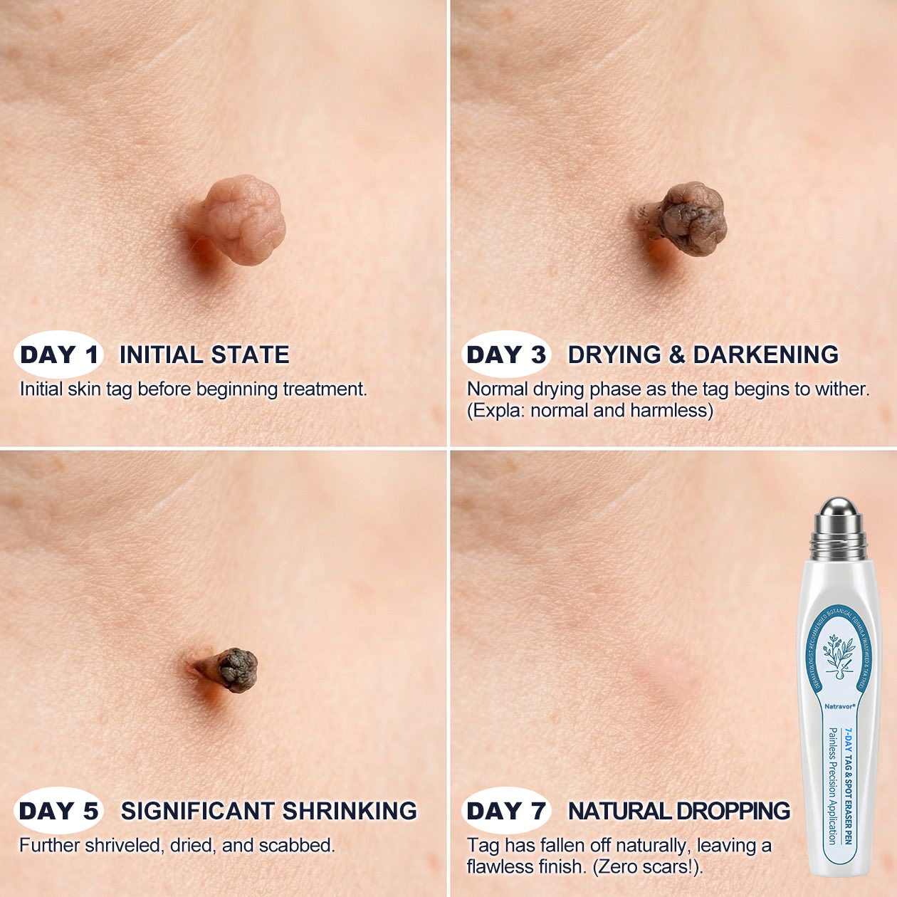 👩🏻‍⚕️𝐎𝐟𝐟𝐢𝐜𝐢𝐚𝐥 𝐁𝐫𝐚𝐧𝐝 𝐒𝐭𝐨𝐫𝐞 |✅Natravor® 7-𝐷𝑎𝑦 𝗧𝐚𝐠 & 𝗦𝗽𝐨𝐭 𝐄𝐫𝒂𝒔𝒆𝒓(Zero Pain, Zero 𝐒𝐜𝐚𝒓𝒔 Rollerball)